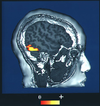 A computer-enhanced fMRI scan of a person looking at faces.  The image indicates increased blood flow in the visual cortex.