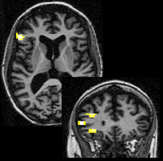 Image showing activation in the frontal cortex of a patient with global amnesia.